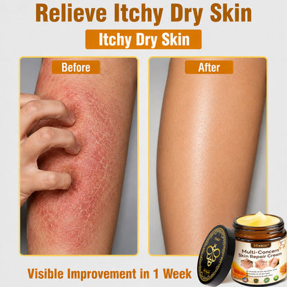 ✨✨HISKIN® Multi-Concern Skin Repair Cream (One powerful cream to repair inflammation, dryness, aging, pigmentation, and visible skin damage.)